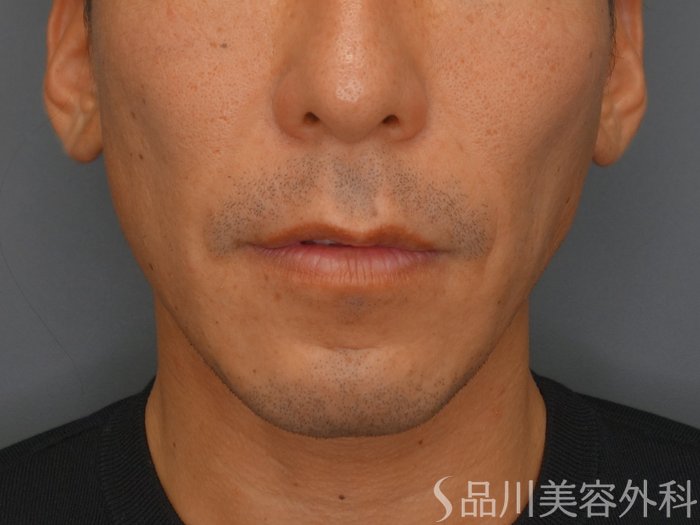 症例NO.65001のBEFORE写真