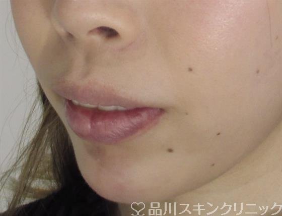 症例NO.35177のAFTER写真