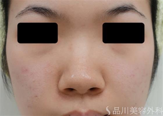 症例NO.25657のBEFORE写真