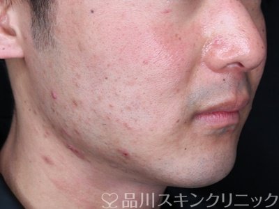 症例NO.72833のBEFORE写真