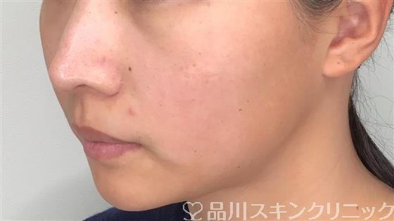 症例NO.59309のBEFORE写真