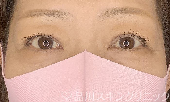 症例NO.70375のAFTER写真