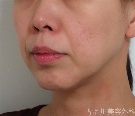 症例NO.36745のBEFORE写真