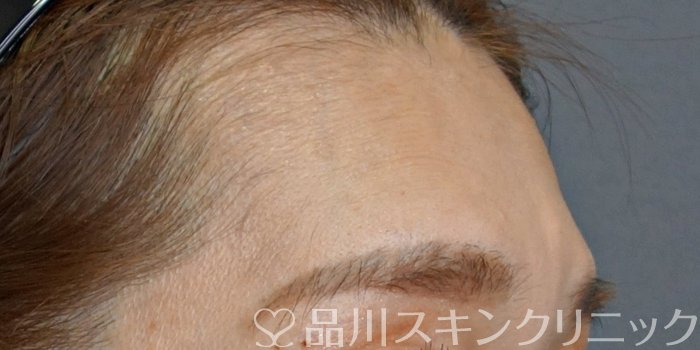 症例NO.74027のBEFORE写真