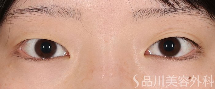 症例NO.72134のBEFORE写真