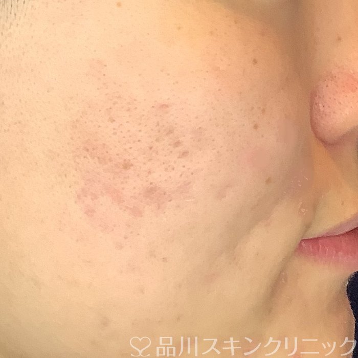症例NO.69486のAFTER写真