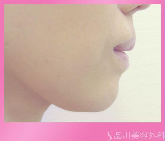 症例NO.813のAFTER写真