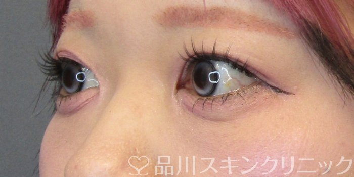 症例NO.74910のAFTER写真