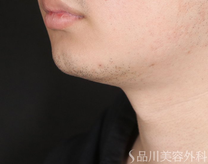 症例NO.72728のBEFORE写真