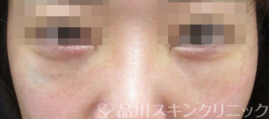 症例NO.64601のAFTER写真