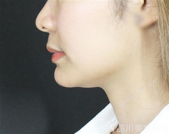 症例NO.61088のAFTER写真