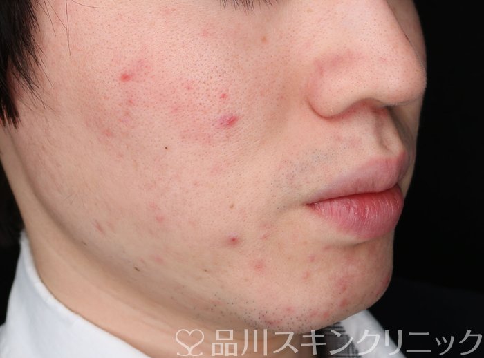 症例NO.73427のAFTER写真