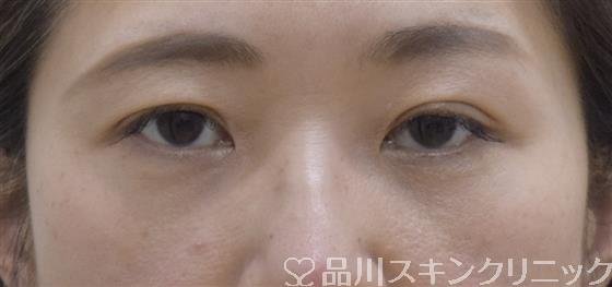 症例NO.54325のAFTER写真