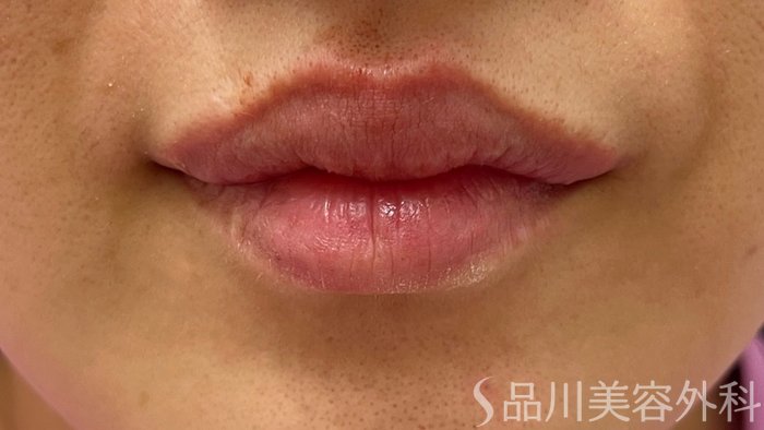 症例NO.70275のAFTER写真