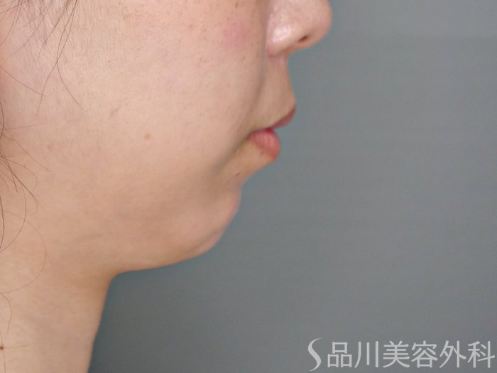 症例NO.70522のBEFORE写真
