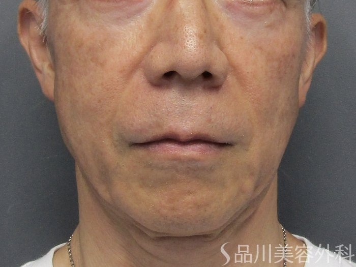 症例NO.74897のBEFORE写真