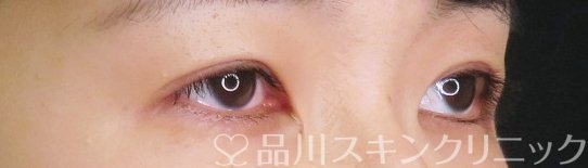 症例NO.67979のAFTER写真