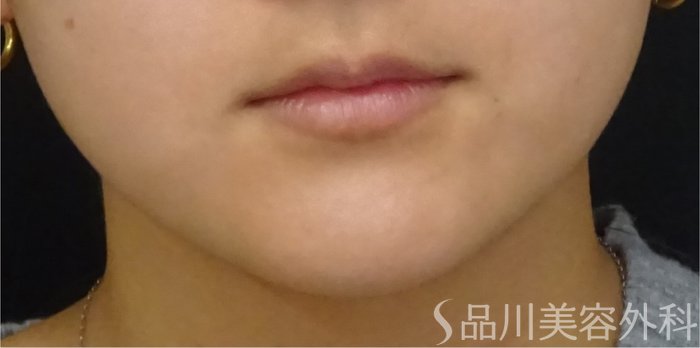 症例NO.69043のBEFORE写真
