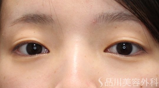 症例NO.74902のBEFORE写真