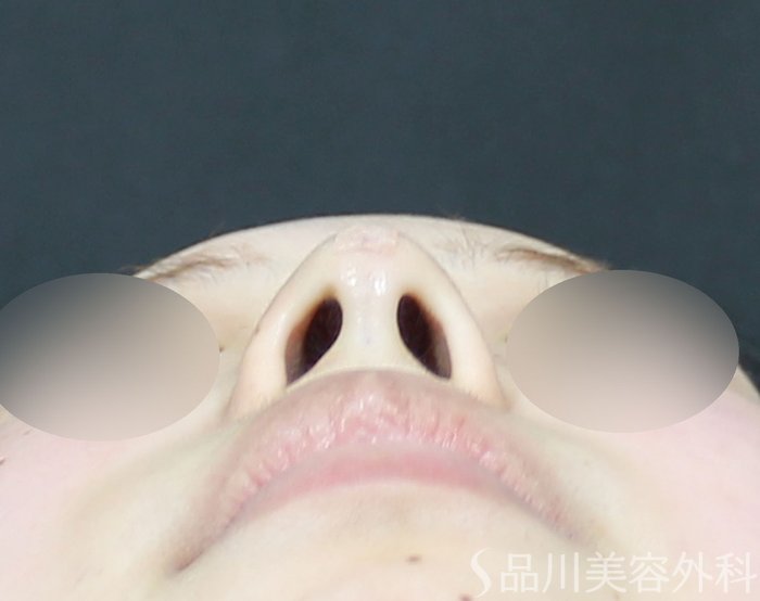 症例NO.71832のAFTER写真