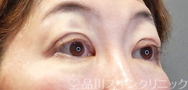 症例NO.67657のAFTER写真