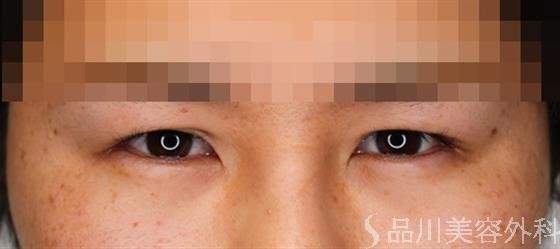 症例NO.50113のBEFORE写真