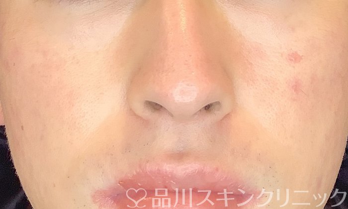 症例NO.69608のAFTER写真