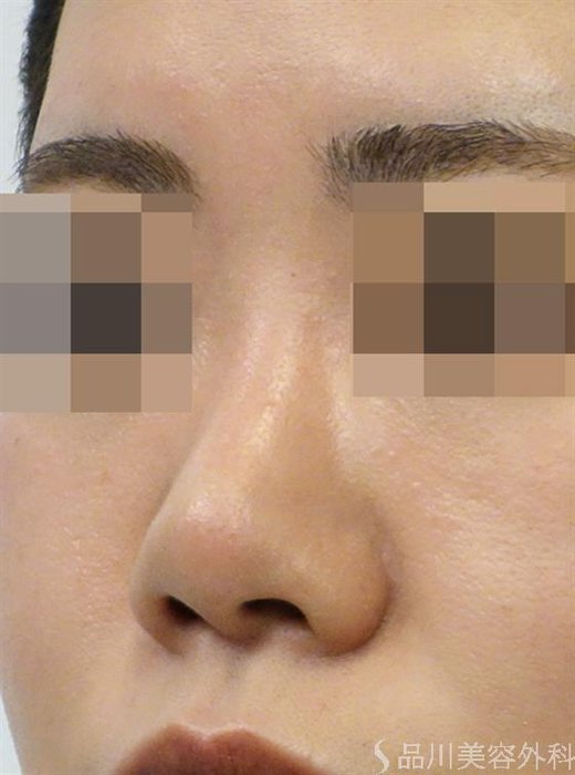 症例NO.39551のBEFORE写真