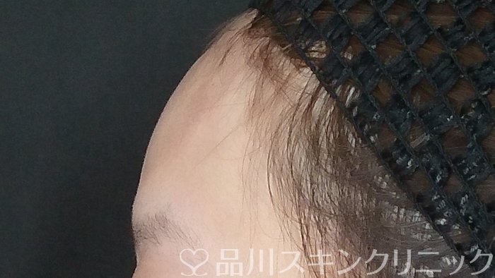 症例NO.72331のAFTER写真