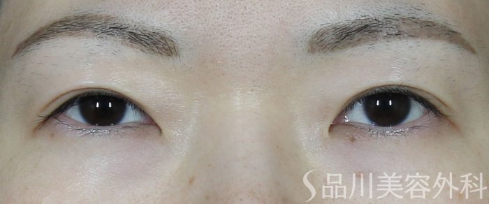 症例NO.71329のBEFORE写真