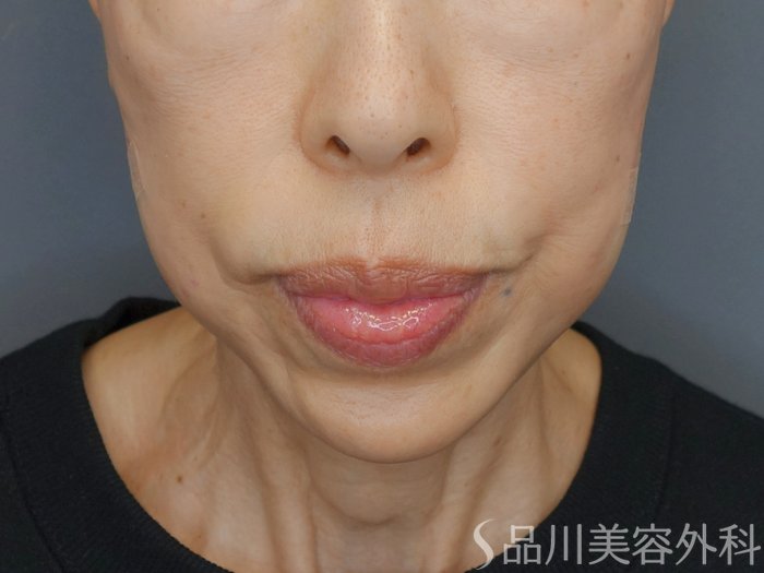 症例NO.72641のAFTER写真