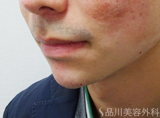症例NO.71141のAFTER写真