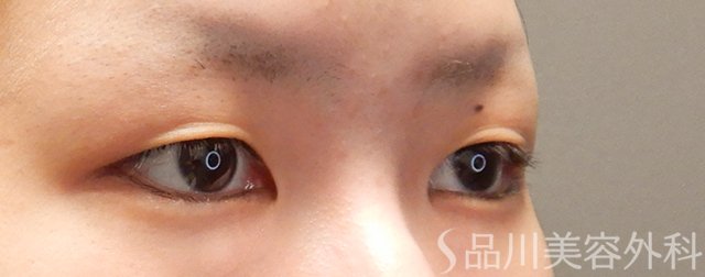 症例NO.72030のBEFORE写真