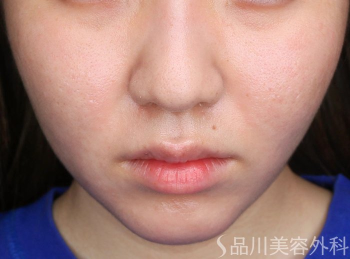 症例NO.64978のAFTER写真