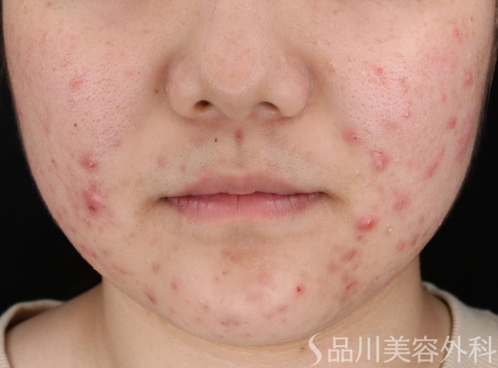 症例NO.73168のBEFORE写真