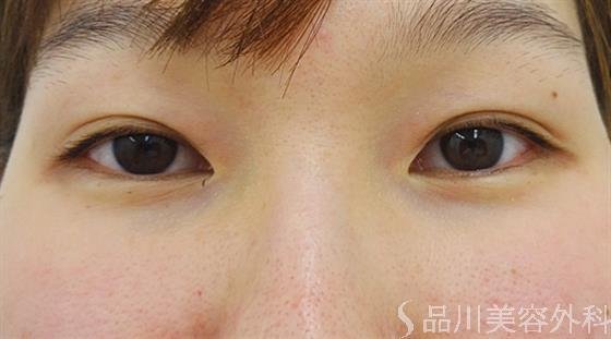 症例NO.36176のAFTER写真