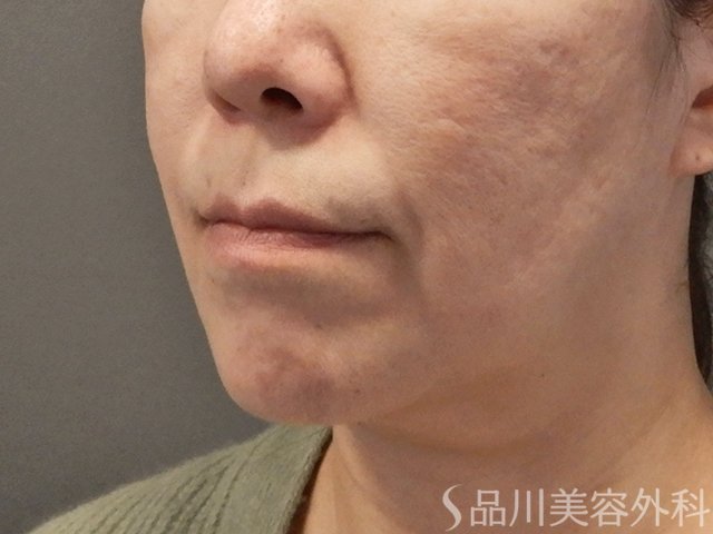 症例NO.73132のBEFORE写真