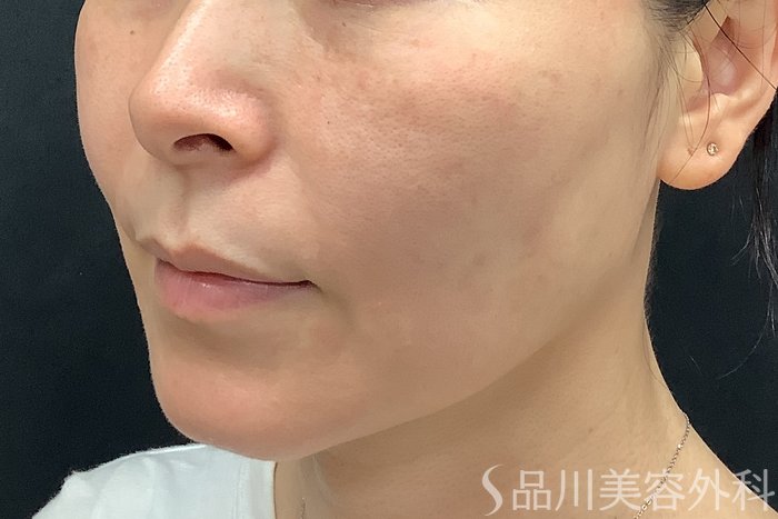 症例NO.71252のBEFORE写真
