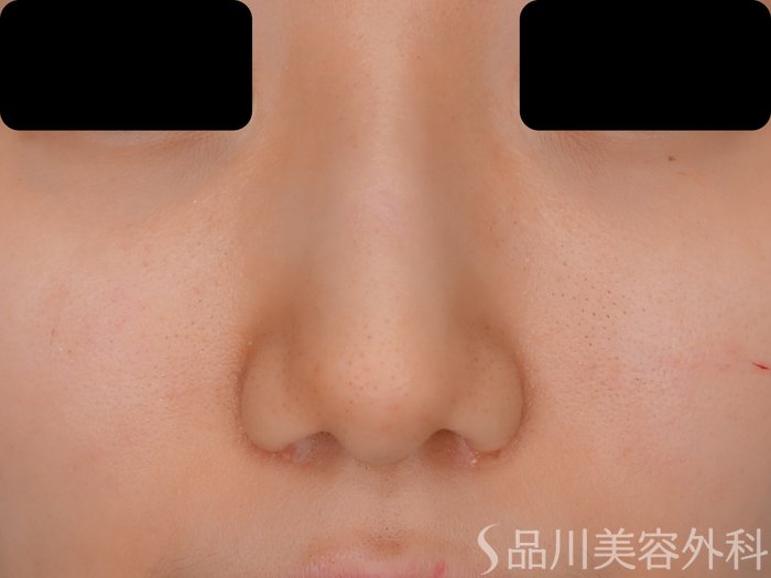 症例NO.70116のAFTER写真