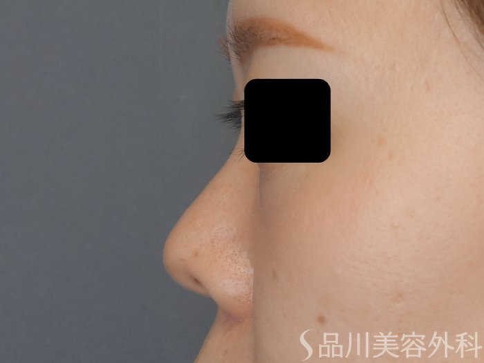 症例NO.70400のBEFORE写真