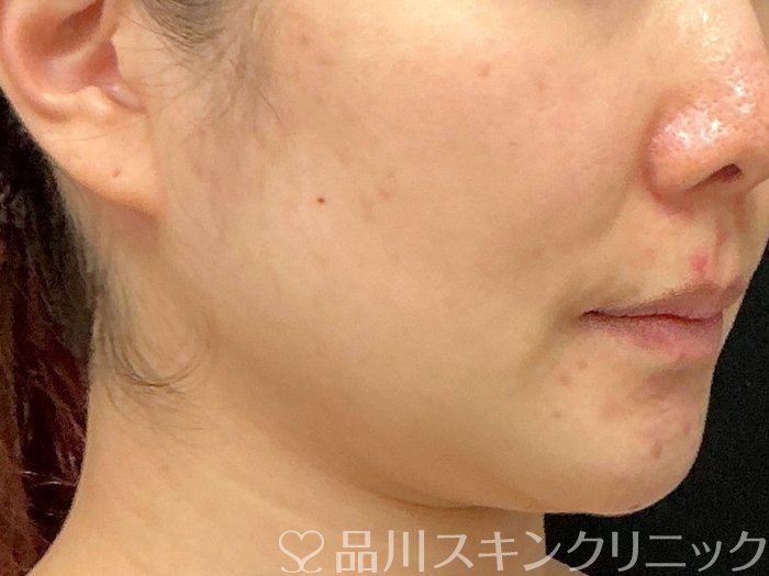 症例NO.74767のBEFORE写真