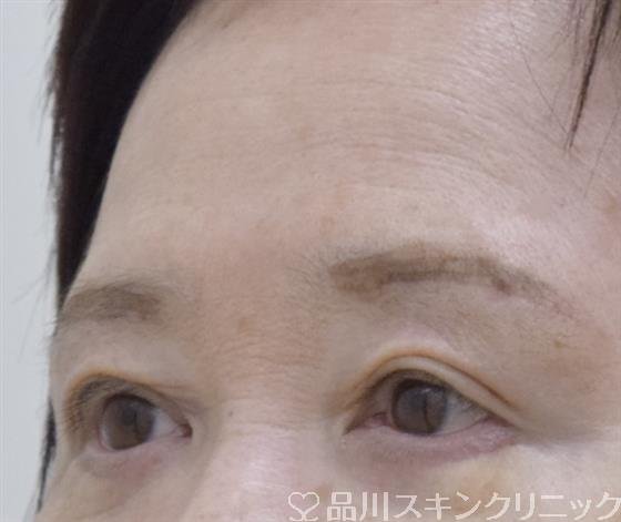 症例NO.59200のAFTER写真