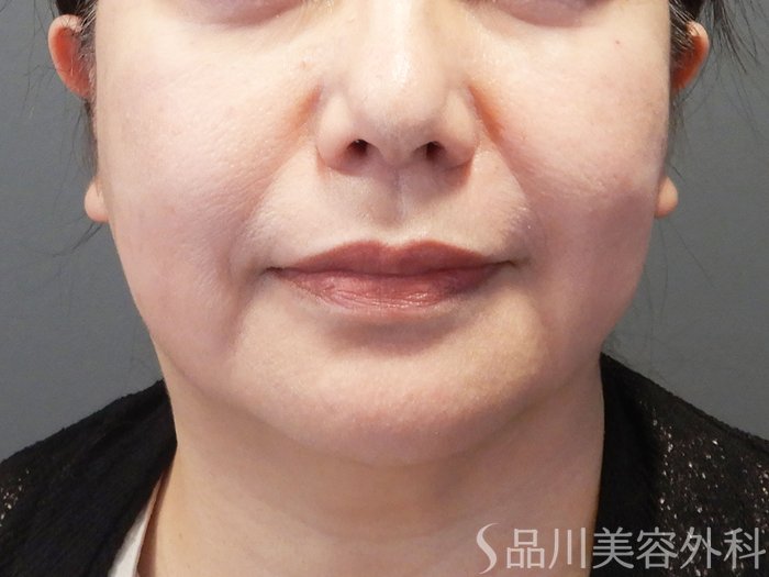 症例NO.74128のBEFORE写真