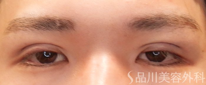 症例NO.69804のAFTER写真