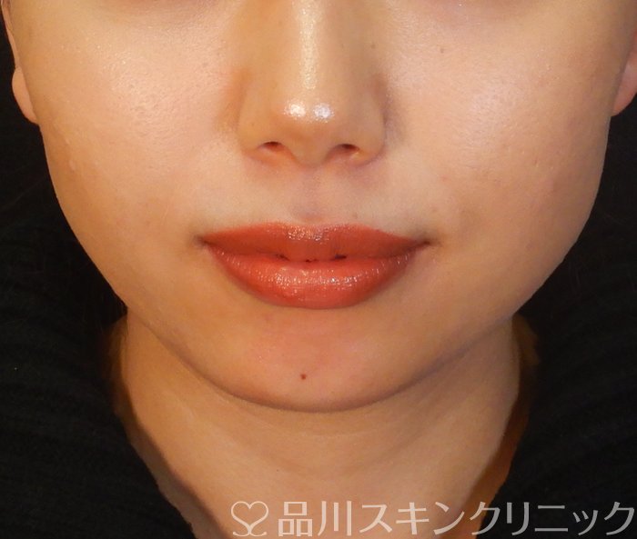 症例NO.66225のBEFORE写真