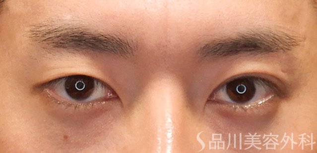 症例NO.72590のBEFORE写真