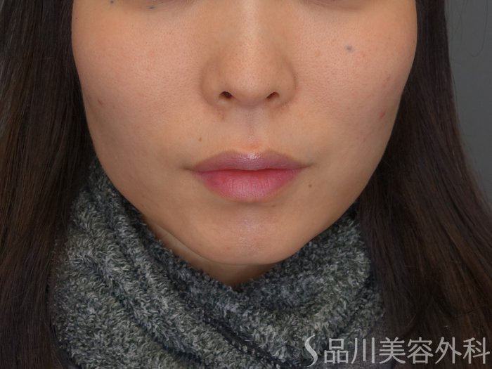 症例NO.74800のBEFORE写真