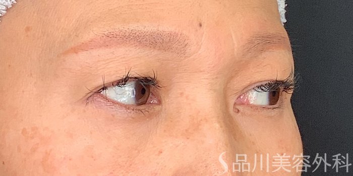 症例NO.71226のBEFORE写真