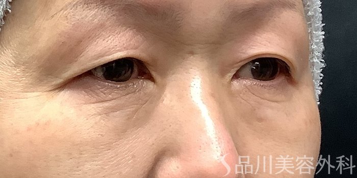 症例NO.63232のBEFORE写真