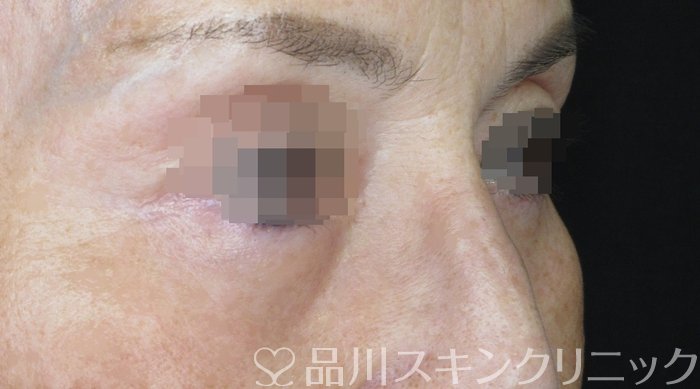 症例NO.62213のAFTER写真